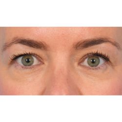 Upper Blepharoplasty Before & After Patient #1873