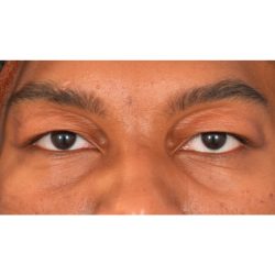 Upper Blepharoplasty Before & After Patient #1312