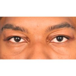 Upper Blepharoplasty Before & After Patient #1312