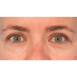 Upper Blepharoplasty Before & After Patient #1873
