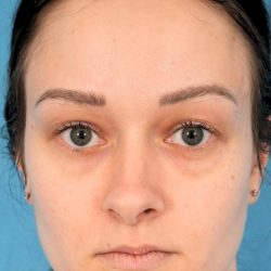 Lower Blepharoplasty Before & After Patient #2084
