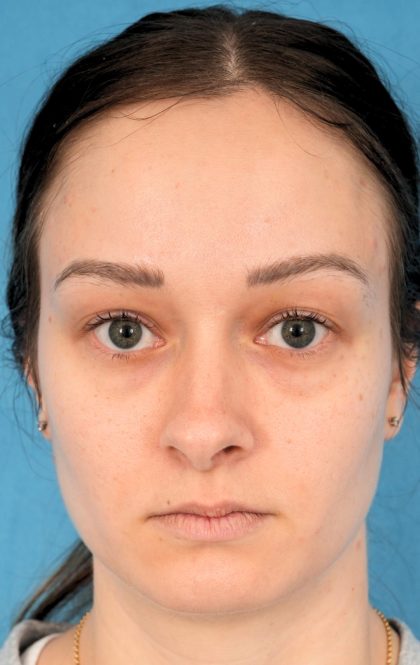 Lower Blepharoplasty Before & After Patient #2084
