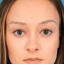 Lower Blepharoplasty Before & After Patient #2084