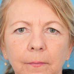 Quad Blepharoplasty Before & After Patient #2049