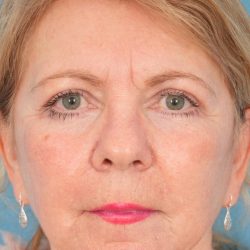 Quad Blepharoplasty Before & After Patient #2049