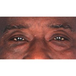 Quad Blepharoplasty Before & After Patient #395