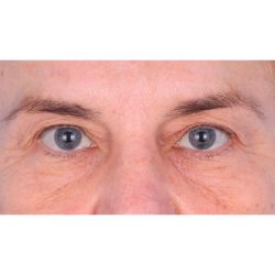 Quad Blepharoplasty Before & After Patient #398
