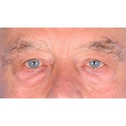 Quad Blepharoplasty Before & After Patient #396