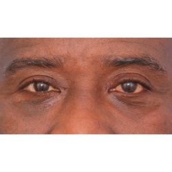 Quad Blepharoplasty Before & After Patient #395