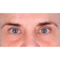 Quad Blepharoplasty Before & After Patient #398