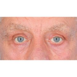 Quad Blepharoplasty Before & After Patient #396