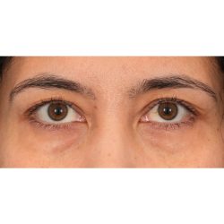 Quad Blepharoplasty Before & After Patient #2128
