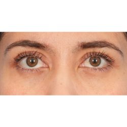 Quad Blepharoplasty Before & After Patient #2128