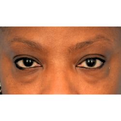 Lower Blepharoplasty Before & After Patient #2119