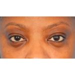 Lower Blepharoplasty Before & After Patient #2119