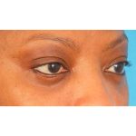 Lower Blepharoplasty Before & After Patient #2119