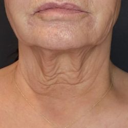 Non-Surgical Before & After Patient #2214