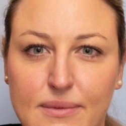 Non-Surgical Before & After Patient #2217