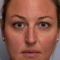 Non-Surgical Before & After Patient #2217