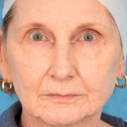 Morpheus8 Before & After Patient #2331