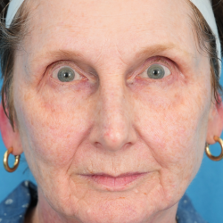 Morpheus8 Before & After Patient #2331