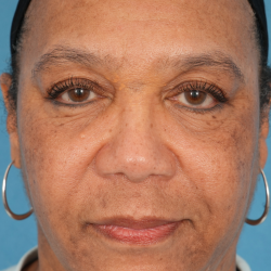 Morpheus8 Before & After Patient #2314