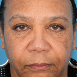 Morpheus8 Before & After Patient #2314