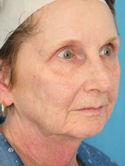 Patient #2331 Morpheus8 Before and After Photos Chicago, IL - Plastic ...