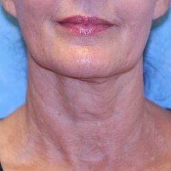 Non-Surgical Before & After Patient #2211