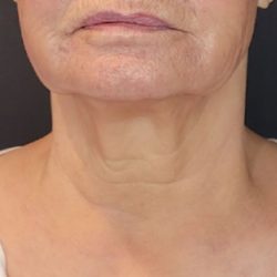 Non-Surgical Before & After Patient #2214