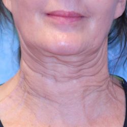 Non-Surgical Before & After Patient #2211