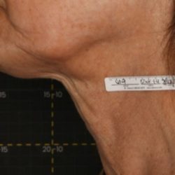 Non-Surgical Before & After Patient #2222