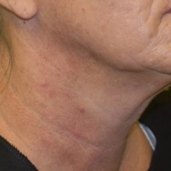 Non-Surgical Before & After Patient #2225