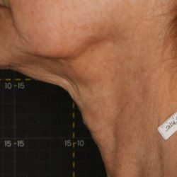 Non-Surgical Before & After Patient #2222