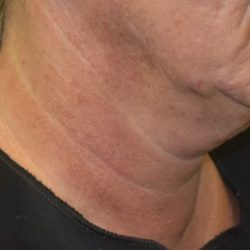 Non-Surgical Before & After Patient #2225