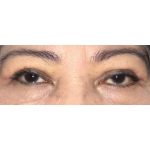 Double Eyelid Surgery Before & After Patient #2457