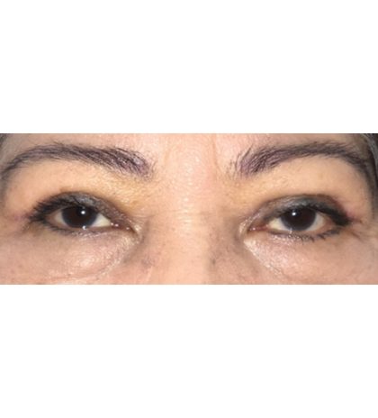 Double Eyelid Surgery Before & After Patient #2457