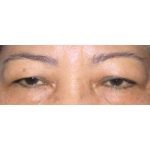 Double Eyelid Surgery Before & After Patient #2457