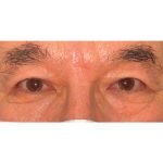 Double Eyelid Surgery Before & After Patient #2473