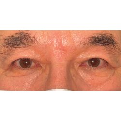 Double Eyelid Surgery Before & After Patient #2473