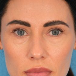 Lower Blepharoplasty Before & After Patient #2441