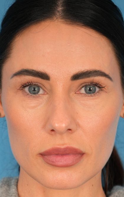 Lower Blepharoplasty Before & After Patient #2441