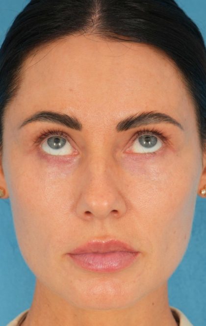 Lower Blepharoplasty Before & After Patient #2441