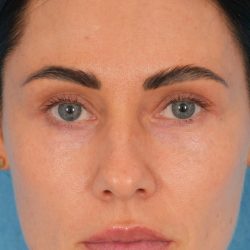 Lower Blepharoplasty Before & After Patient #2441