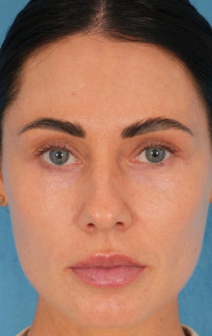 Lower Blepharoplasty Before & After Patient #2441