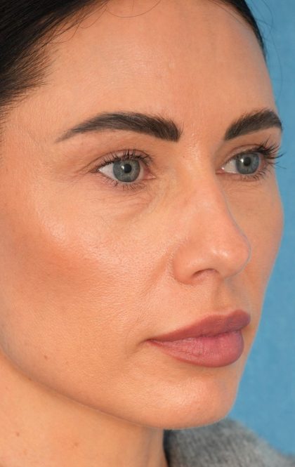 Lower Blepharoplasty Before & After Patient #2441