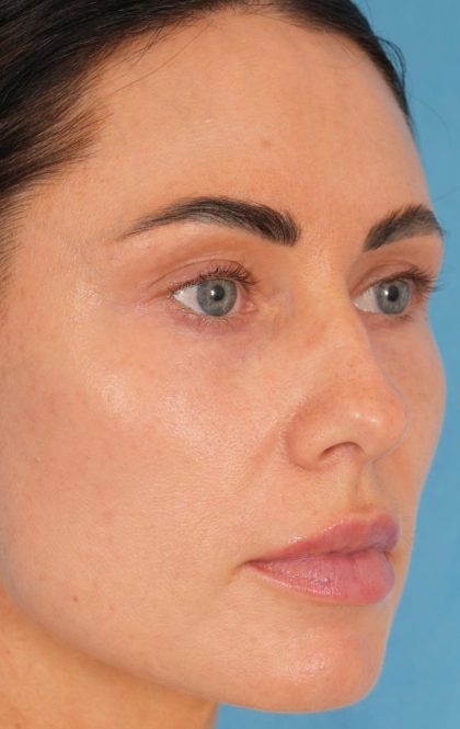 Lower Blepharoplasty Before & After Patient #2441