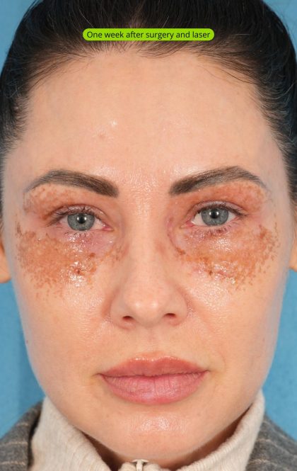 Lower Blepharoplasty Before & After Patient #2441