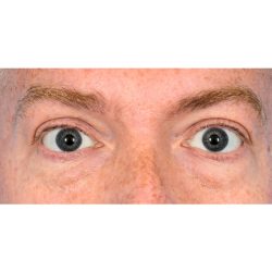 Lower Blepharoplasty Before & After Patient #2386
