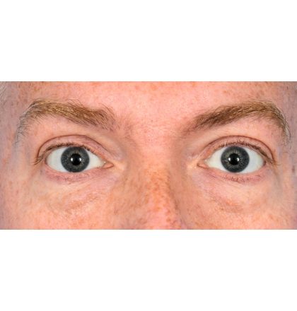 Lower Blepharoplasty Before & After Patient #2386